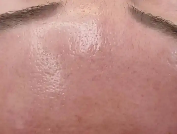 Nachher – Skin Booster