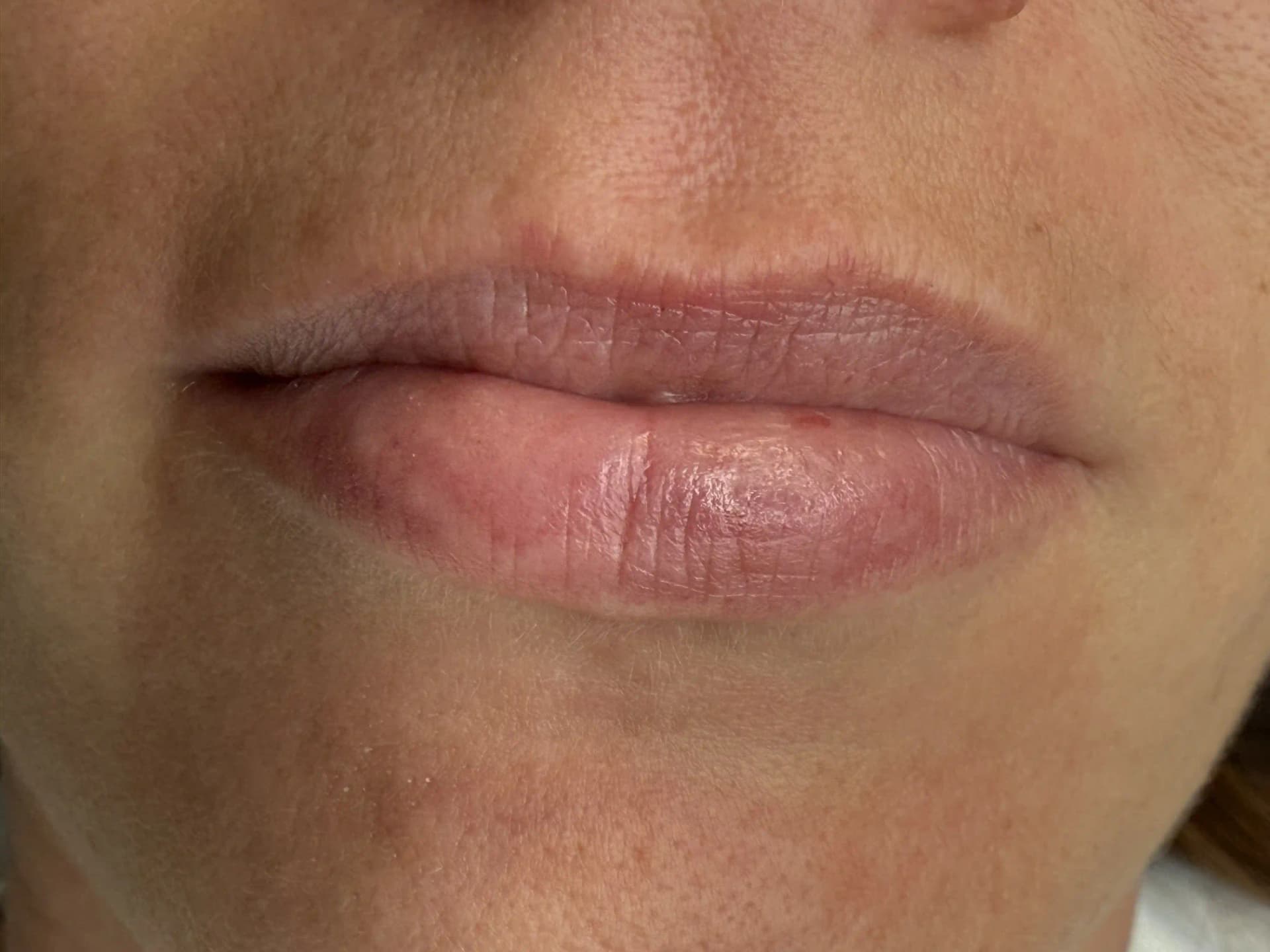 Vorher – Sensual Lips