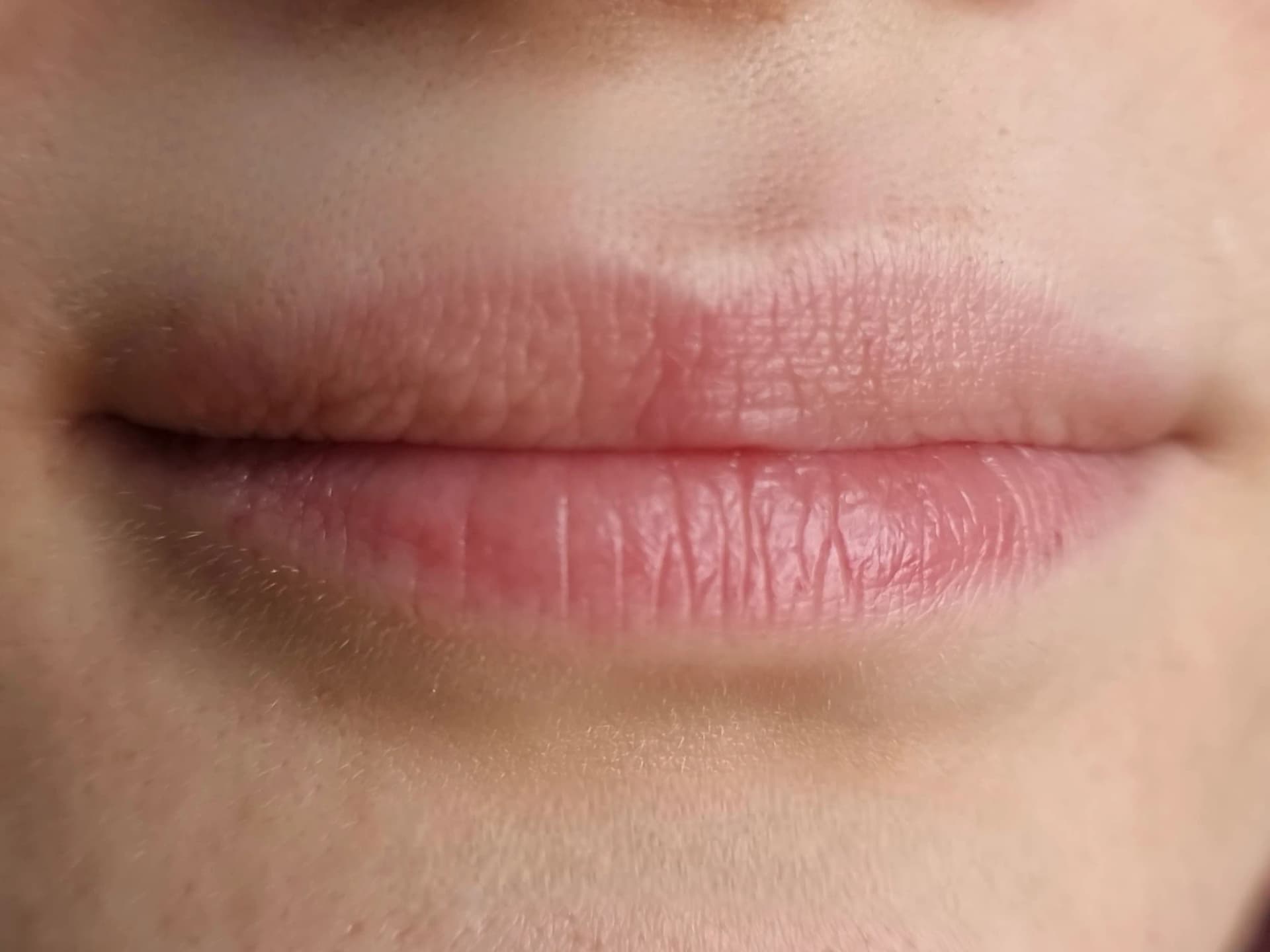Vorher – Lipstick Effekt