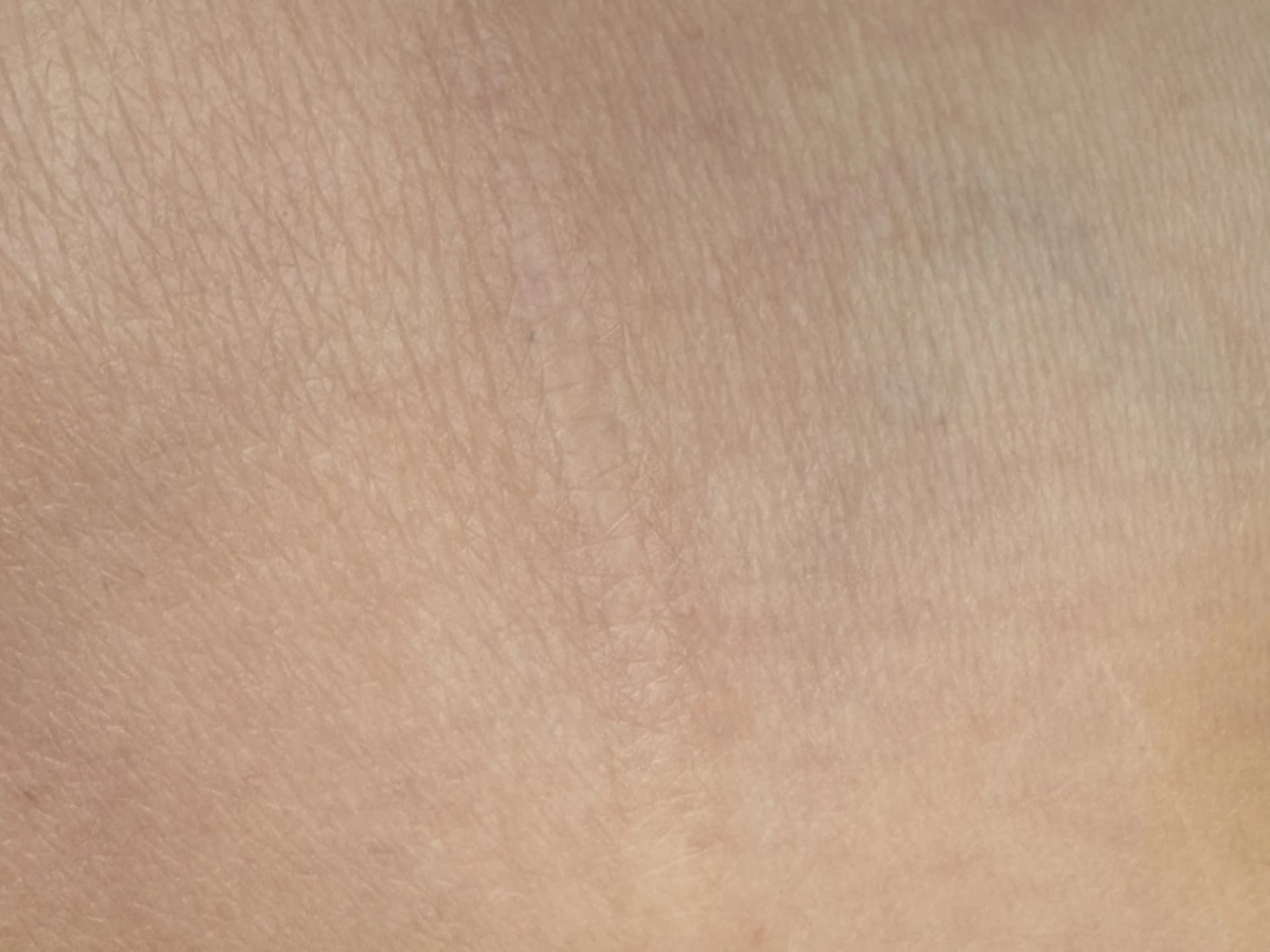 Nachher – Narbenpigmentierung