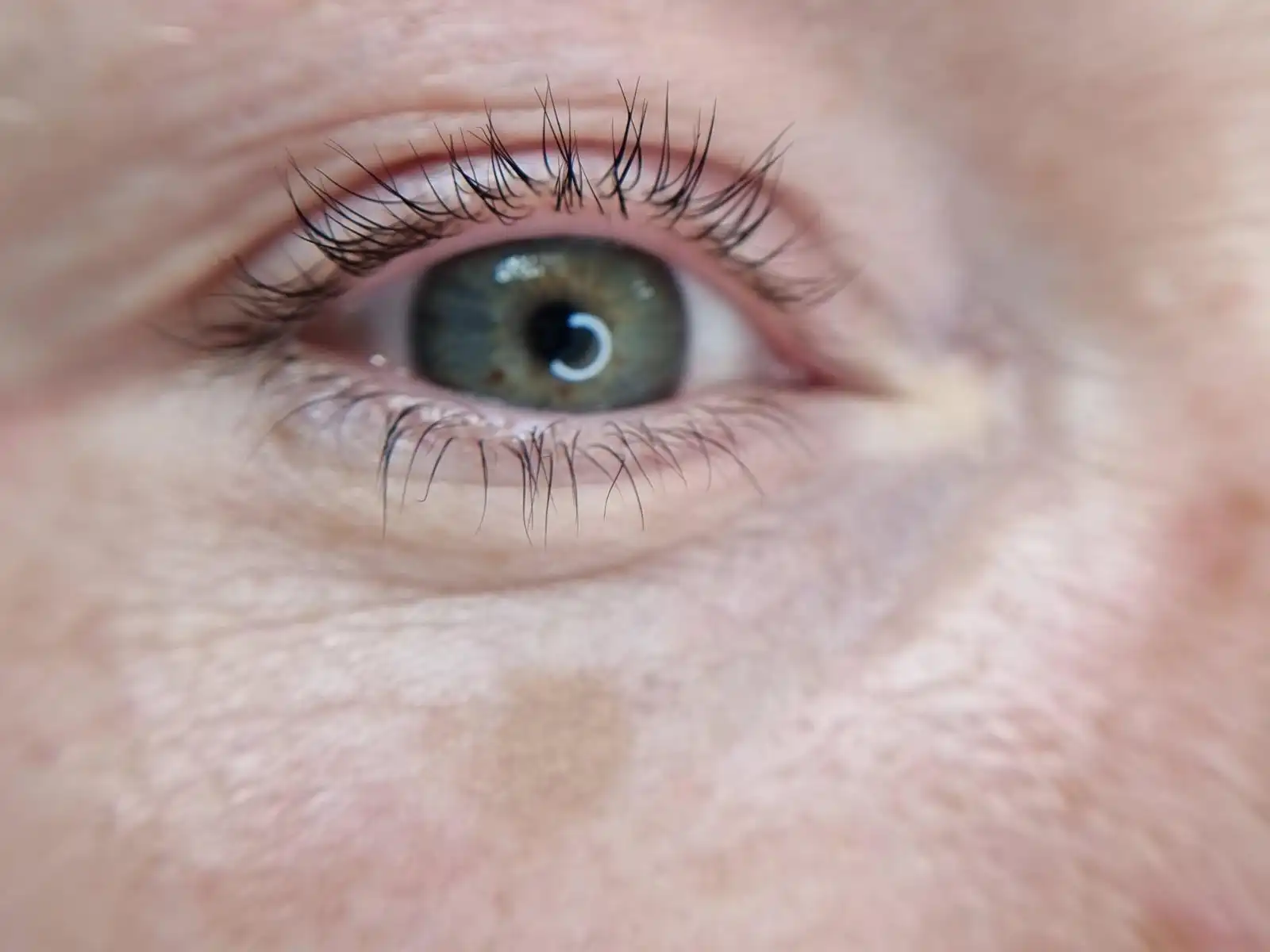 Vorher – Wimpernkranzverdichtung