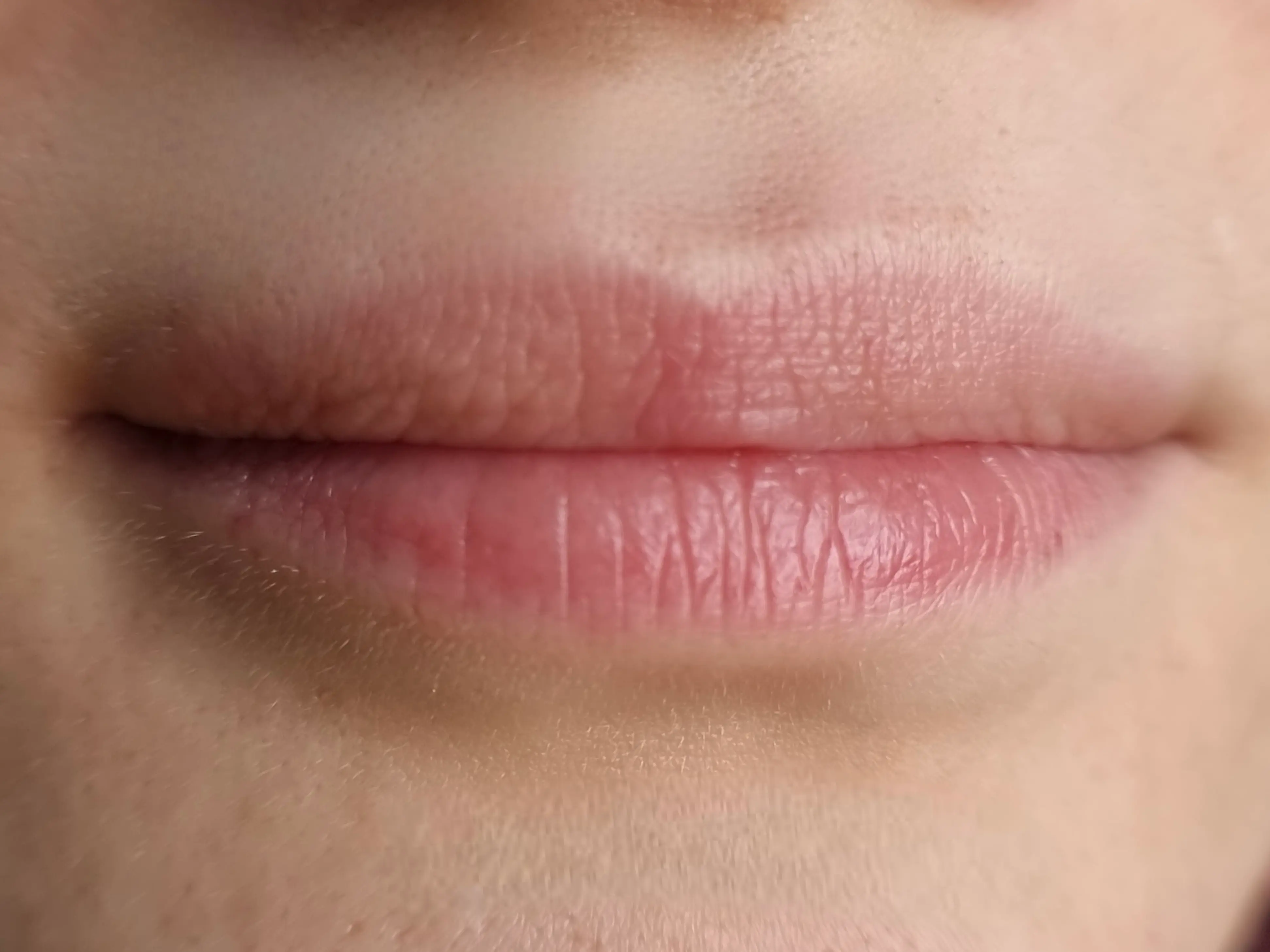 Vorher – Lipstick Effekt